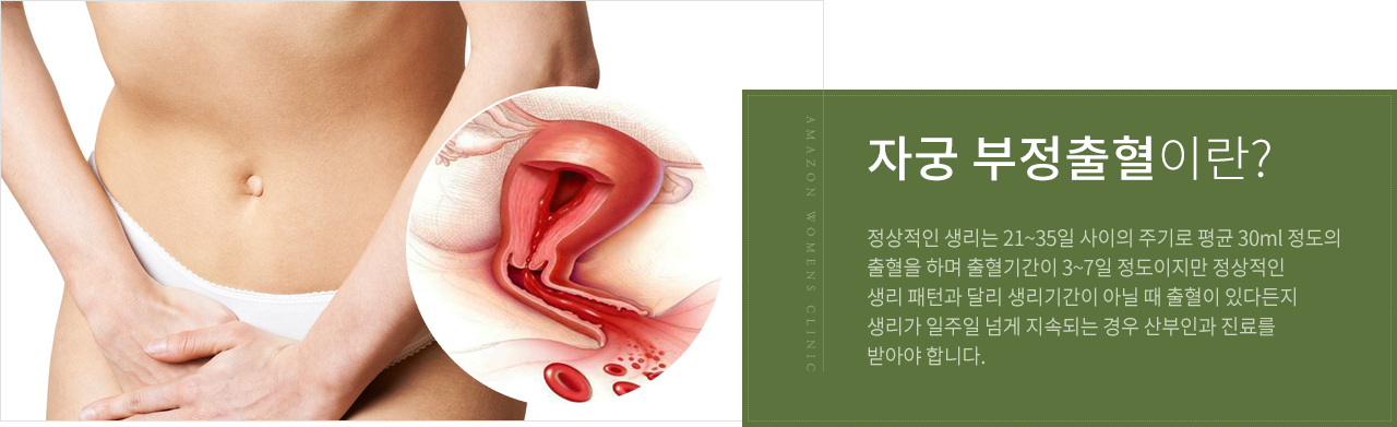 부정출혈이란?