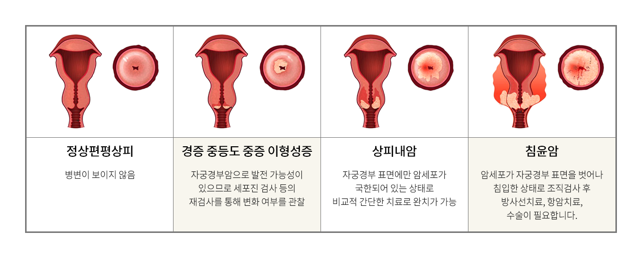 정상편평상피 / 경증 중등도 중증이형성증 / 상피내암 / 침윤암