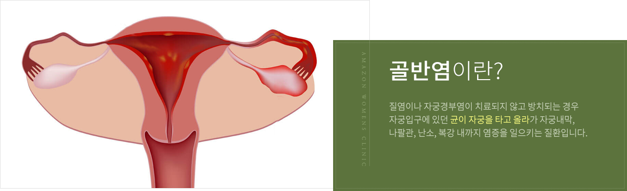 골반염이란?