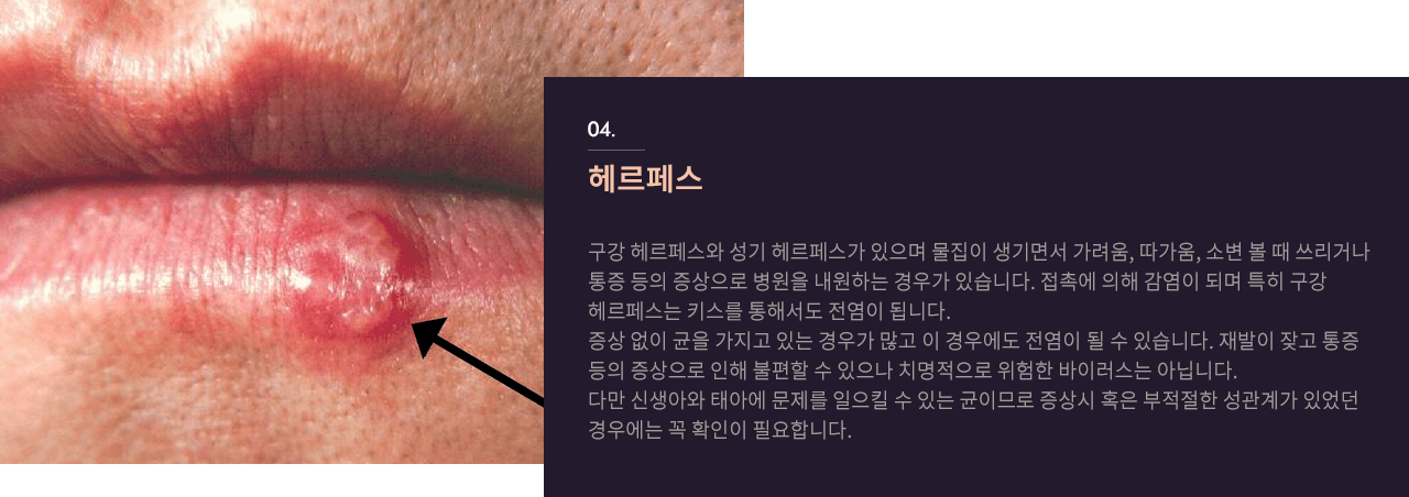 헤르페스