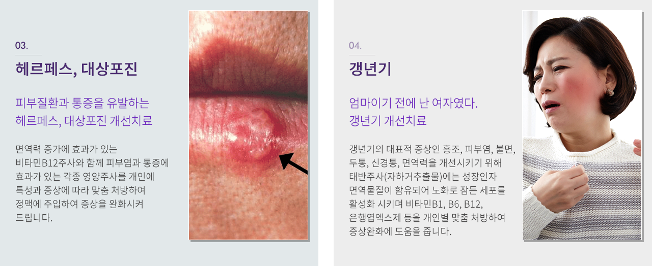 헤르페스, 대상포진 / 갱년기